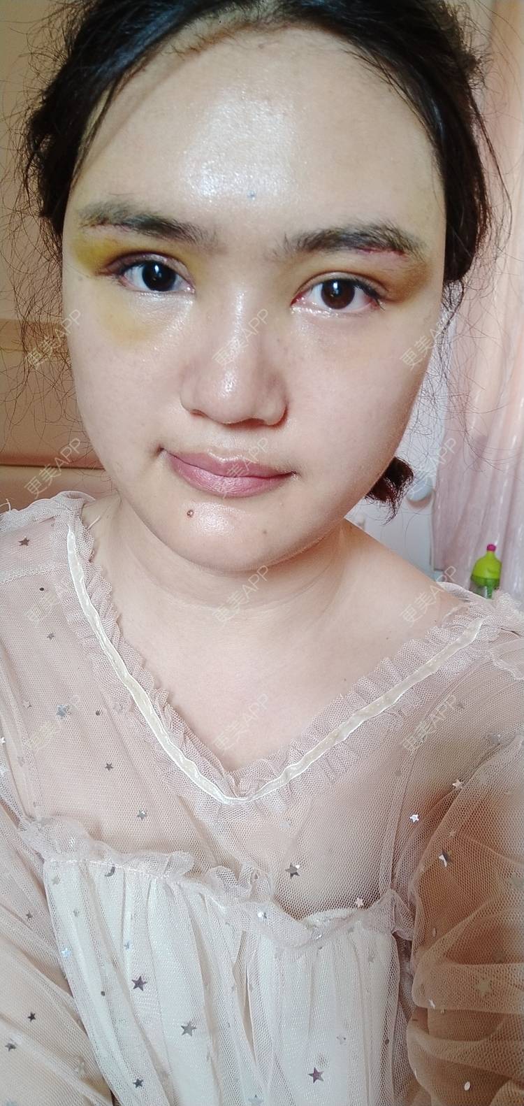 更美 - 红薯冰的硅胶垫眉弓经验 | 北京 | 硅胶垫眉弓