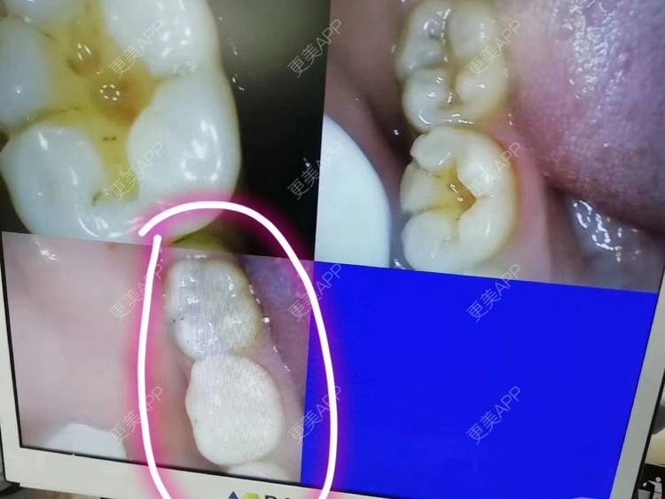 更美 - 更美用户jz7uDI5DsY的树脂补牙经验 | 树脂补牙 | 重庆