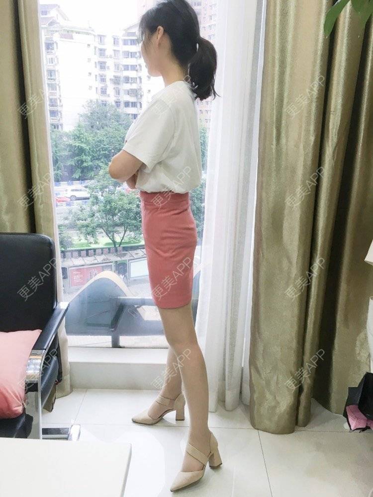 更美 - 更美用户CQFZ0nNp0z的臀部经验 | 自体脂肪丰臀 | 吸脂塑臀 | 假体丰臀 | 胶原蛋白丰臀 | 腰腹吸脂 | 吸脂瘦大腿 | 手臂吸脂