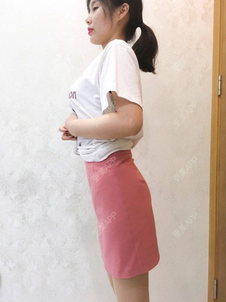 更美 - 更美用户CQFZ0nNp0z的臀部经验 | 自体脂肪丰臀 | 吸脂塑臀 | 假体丰臀 | 胶原蛋白丰臀 | 腰腹吸脂 | 吸脂瘦大腿 | 手臂吸脂