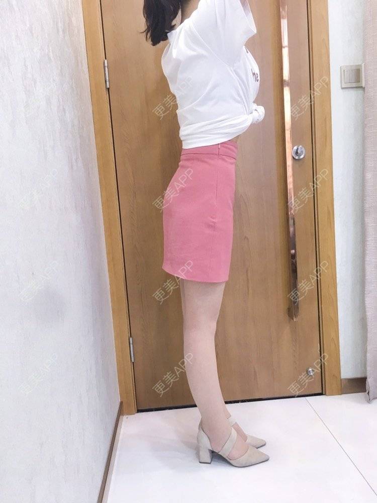 更美 - 更美用户CQFZ0nNp0z的臀部经验 | 自体脂肪丰臀 | 吸脂塑臀 | 假体丰臀 | 胶原蛋白丰臀 | 腰腹吸脂 | 吸脂瘦大腿 | 手臂吸脂