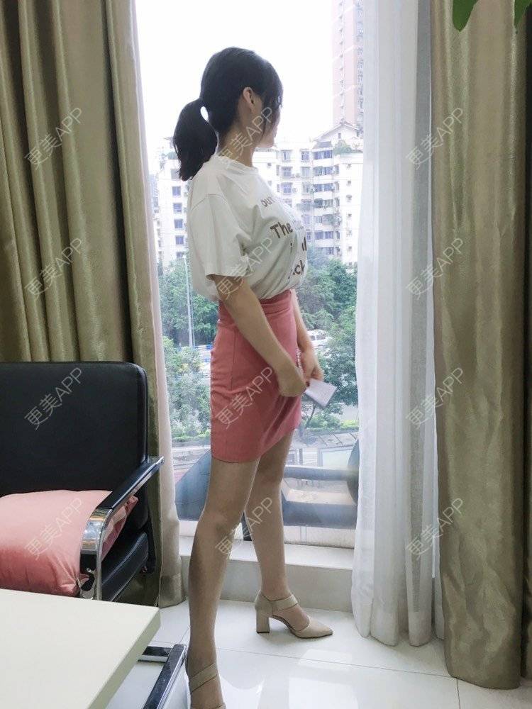 更美 - 更美用户CQFZ0nNp0z的臀部经验 | 自体脂肪丰臀 | 吸脂塑臀 | 假体丰臀 | 胶原蛋白丰臀 | 腰腹吸脂 | 吸脂瘦大腿 | 手臂吸脂
