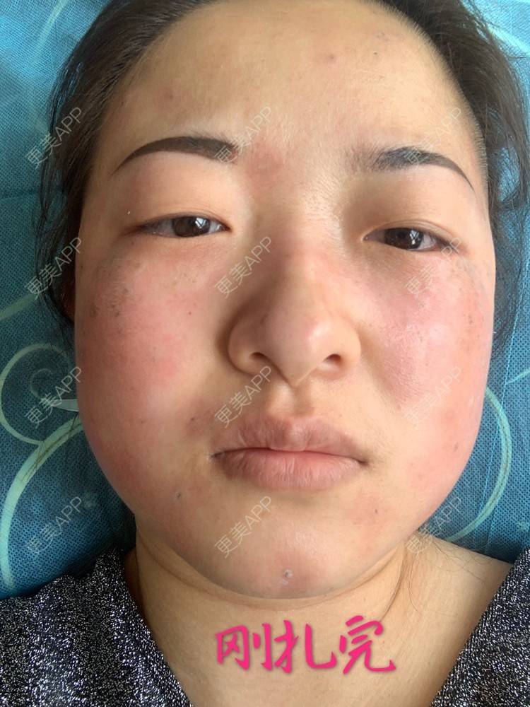 更美 - 好好学习，CPA的化学剥脱淡斑经验 | 化学剥脱淡斑