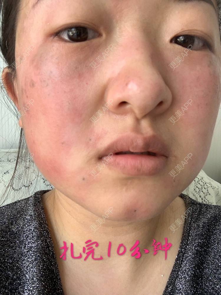 更美 - 好好学习，CPA的化学剥脱淡斑经验 | 化学剥脱淡斑