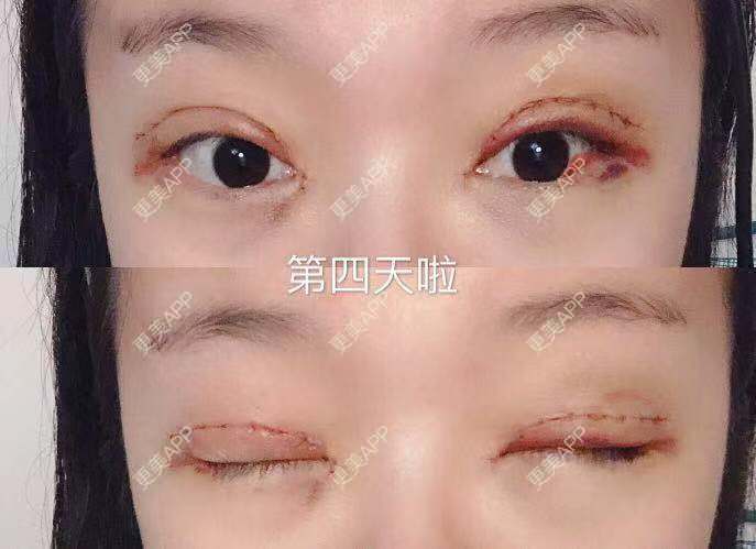 更美 - 刘艳 医生的眼部多项经验 | 眼部多项