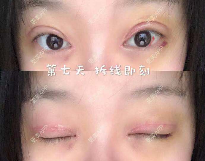 更美 - 刘艳 医生的眼部多项经验 | 眼部多项