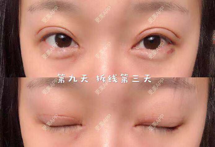 更美 - 刘艳 医生的眼部多项经验 | 眼部多项