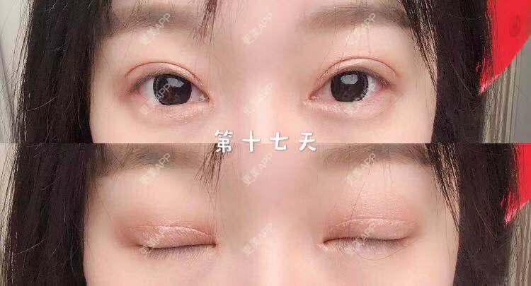 更美 - 刘艳 医生的眼部多项经验 | 眼部多项