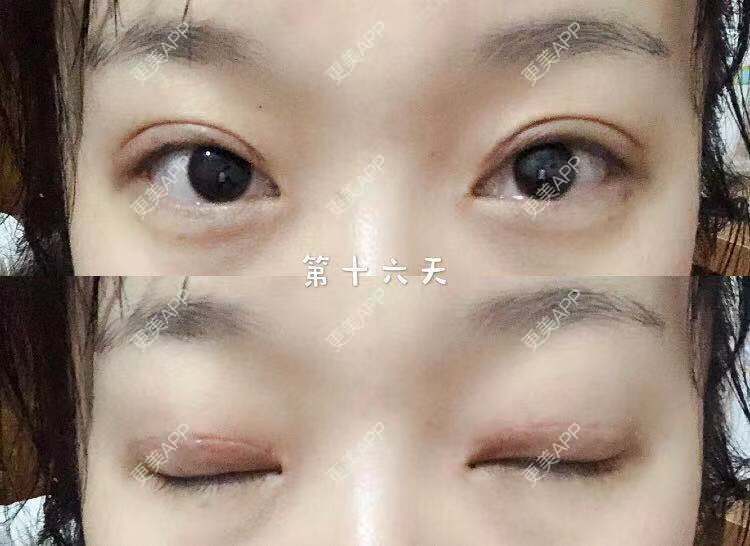 更美 - 刘艳 医生的眼部多项经验 | 眼部多项