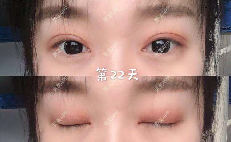 更美 - 刘艳 医生的眼部多项经验 | 眼部多项