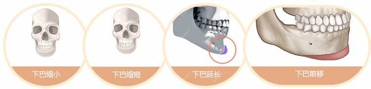 更美 - 李志海 医生的颧骨颧弓经验 | 颧骨颧弓 | 颧骨内推 | 下颌角 | 颧弓降低 | 下颌角切除 | 上海