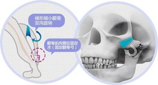 更美 - 李志海 医生的颧骨颧弓经验 | 颧骨颧弓 | 颧骨内推 | 下颌角 | 颧弓降低 | 下颌角切除 | 上海