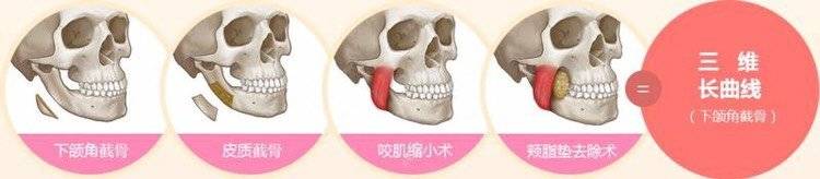更美 - 李志海 医生的颧骨颧弓经验 | 颧骨颧弓 | 颧骨内推 | 下颌角 | 颧弓降低 | 下颌角切除 | 上海