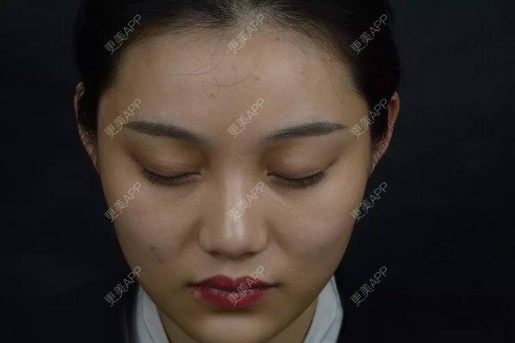 更美 - 更美用户r6wASEs45i的自体脂肪填充泪沟经验 | 自体脂肪填充泪沟 | 杭州