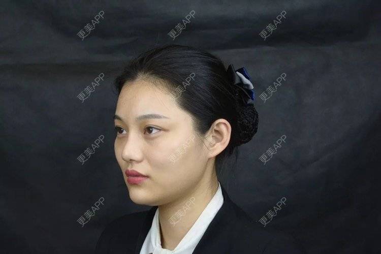 更美 - 更美用户r6wASEs45i的自体脂肪填充泪沟经验 | 自体脂肪填充泪沟 | 杭州