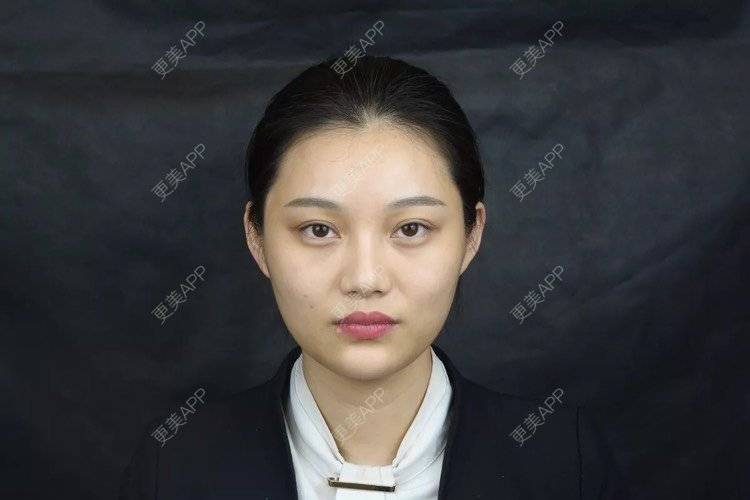 更美 - 更美用户r6wASEs45i的自体脂肪填充泪沟经验 | 自体脂肪填充泪沟 | 杭州