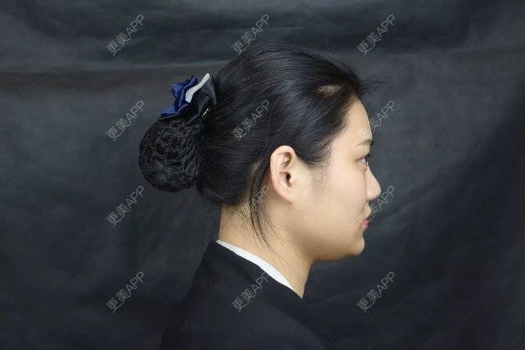 更美 - 更美用户r6wASEs45i的自体脂肪填充泪沟经验 | 自体脂肪填充泪沟 | 杭州