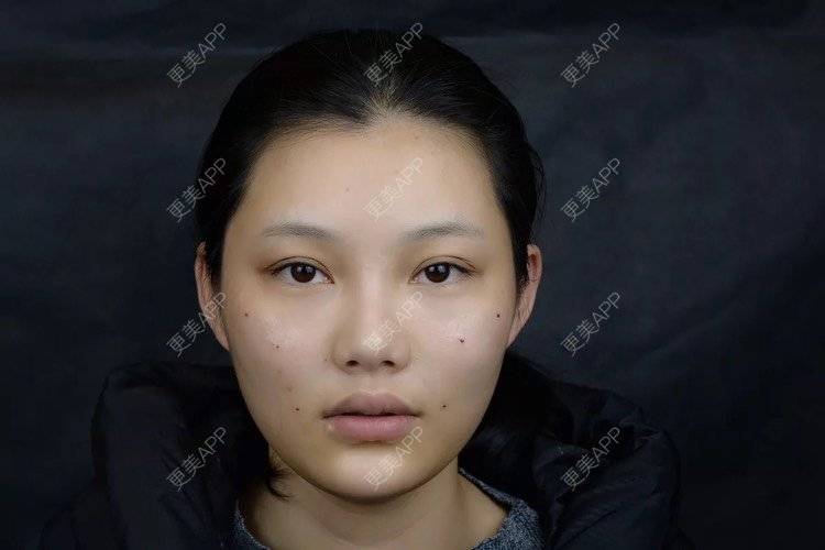 更美 - 更美用户r6wASEs45i的自体脂肪填充泪沟经验 | 自体脂肪填充泪沟 | 杭州