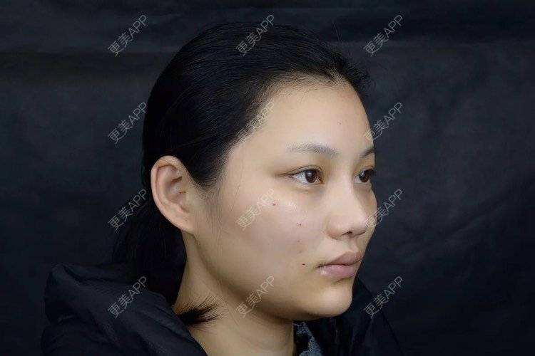 更美 - 更美用户r6wASEs45i的自体脂肪填充泪沟经验 | 自体脂肪填充泪沟 | 杭州