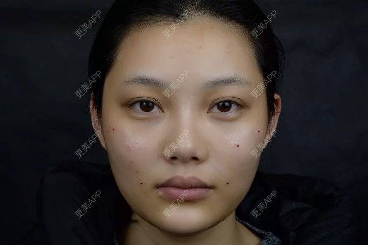 更美 - 更美用户r6wASEs45i的自体脂肪填充泪沟经验 | 自体脂肪填充泪沟 | 杭州