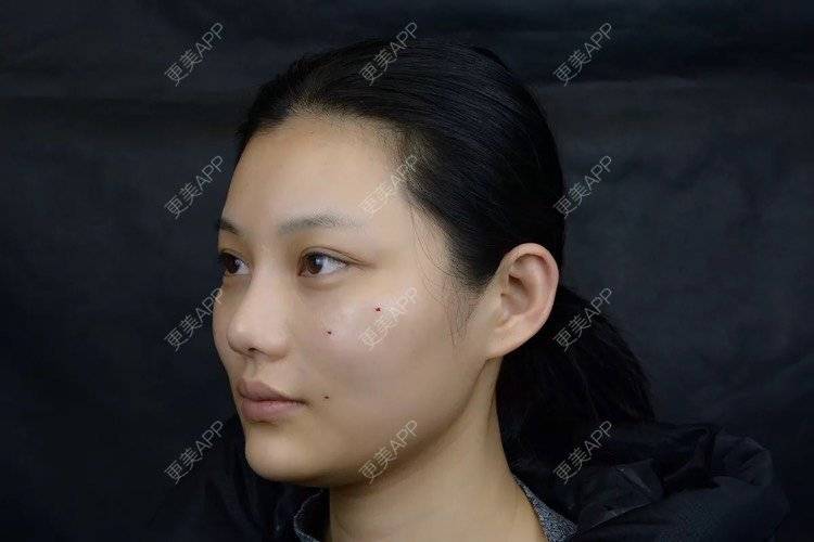 更美 - 更美用户r6wASEs45i的自体脂肪填充泪沟经验 | 自体脂肪填充泪沟 | 杭州