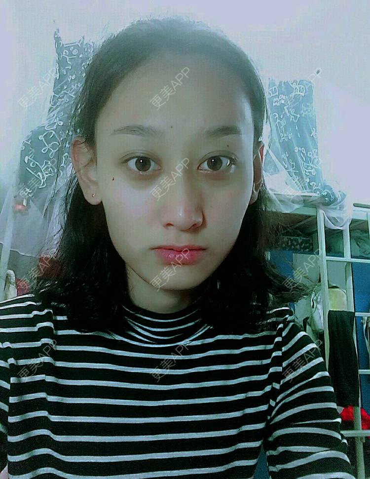 更美 - 小美美的我的微针水光经验 | 少女针 | 微针水光