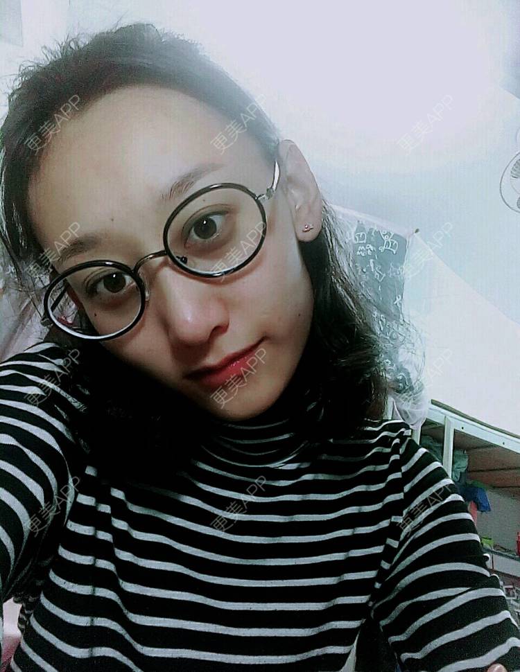更美 - 小美美的我的微针水光经验 | 少女针 | 微针水光
