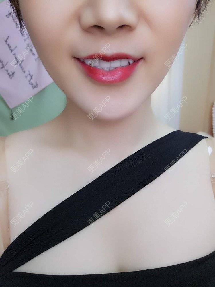 更美 - 一捧保鲜花的唇腭裂修复经验 | 唇综合 | 厚唇改薄 | 胶原蛋白丰唇 | 玻尿酸唇部 | 唇腭裂修复 | 成都 | M唇成形 | 微笑唇手术