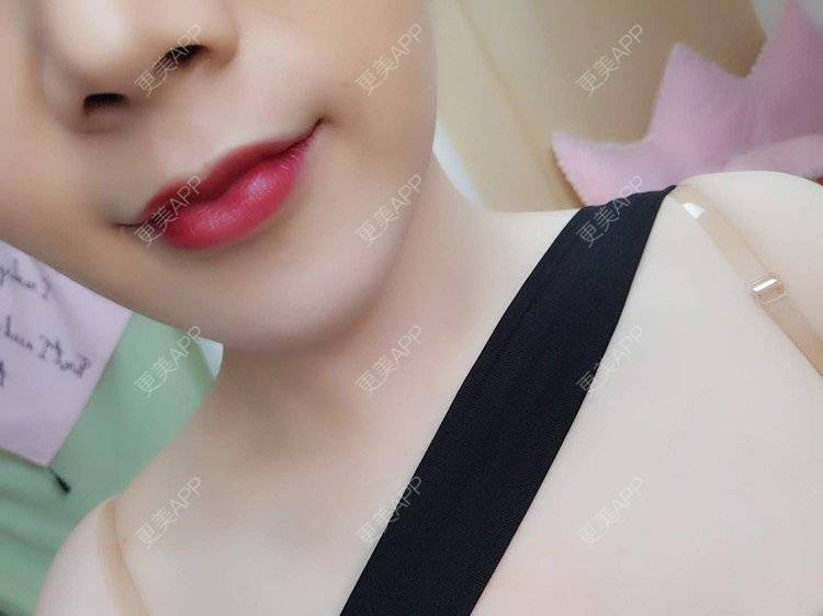 更美 - 一捧保鲜花的唇腭裂修复经验 | 唇综合 | 厚唇改薄 | 胶原蛋白丰唇 | 玻尿酸唇部 | 唇腭裂修复 | 成都 | M唇成形 | 微笑唇手术