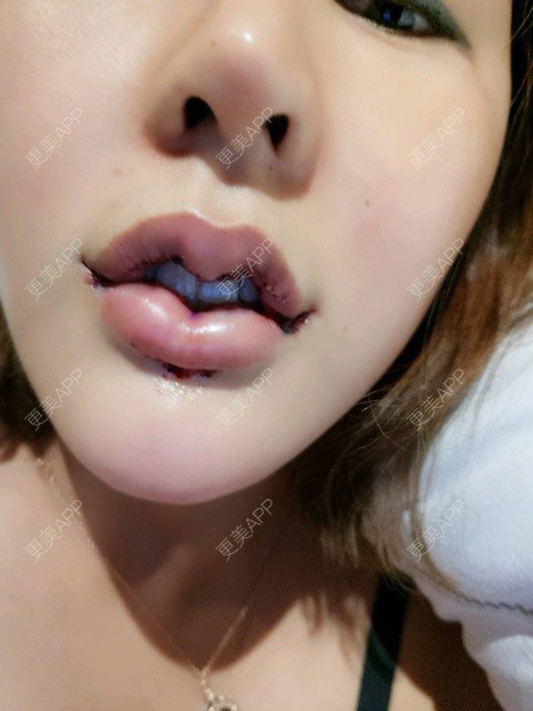 娜依灵儿本尊的唇腭裂修复日记