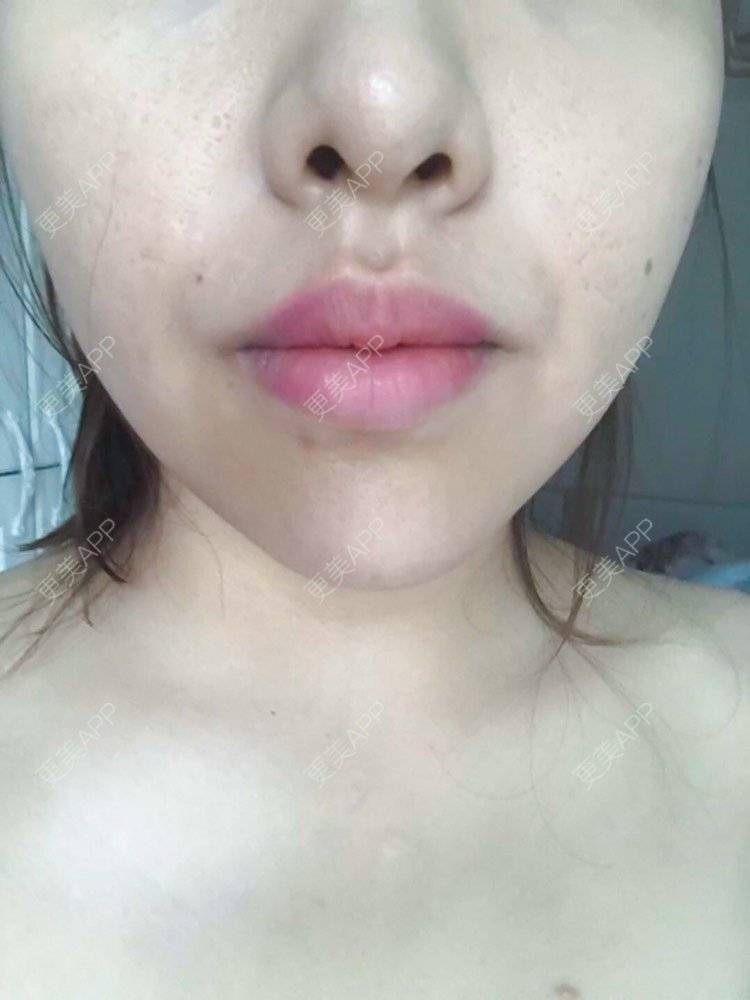 更美 - 夹心巧克力的自体脂肪丰臀经验 | 自体脂肪丰臀 | 吸脂塑臀 | 假体丰臀 | 胶原蛋白丰臀