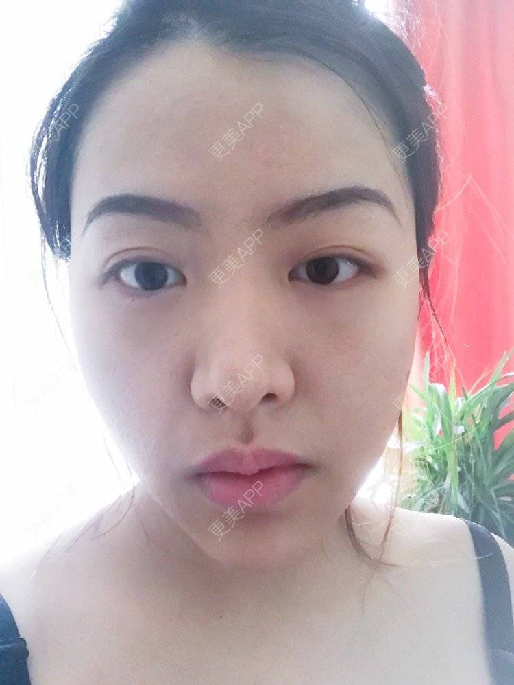 更美 - 夹心巧克力的自体脂肪丰臀经验 | 自体脂肪丰臀 | 吸脂塑臀 | 假体丰臀 | 胶原蛋白丰臀
