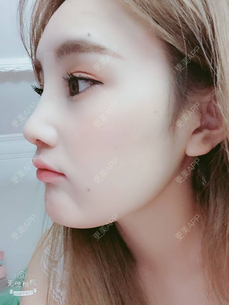 更美 - 爱人不过是碍人的自体软骨垫鼻尖经验 | 自体软骨垫鼻尖 | 膨体隆鼻 | 肋软骨隆鼻 | 鼻中隔软骨隆鼻 | 耳软骨隆鼻 | 上海