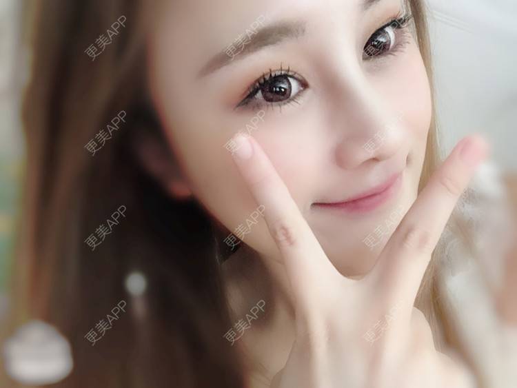 更美 - 爱人不过是碍人的自体软骨垫鼻尖经验 | 自体软骨垫鼻尖 | 膨体隆鼻 | 肋软骨隆鼻 | 鼻中隔软骨隆鼻 | 耳软骨隆鼻 | 上海