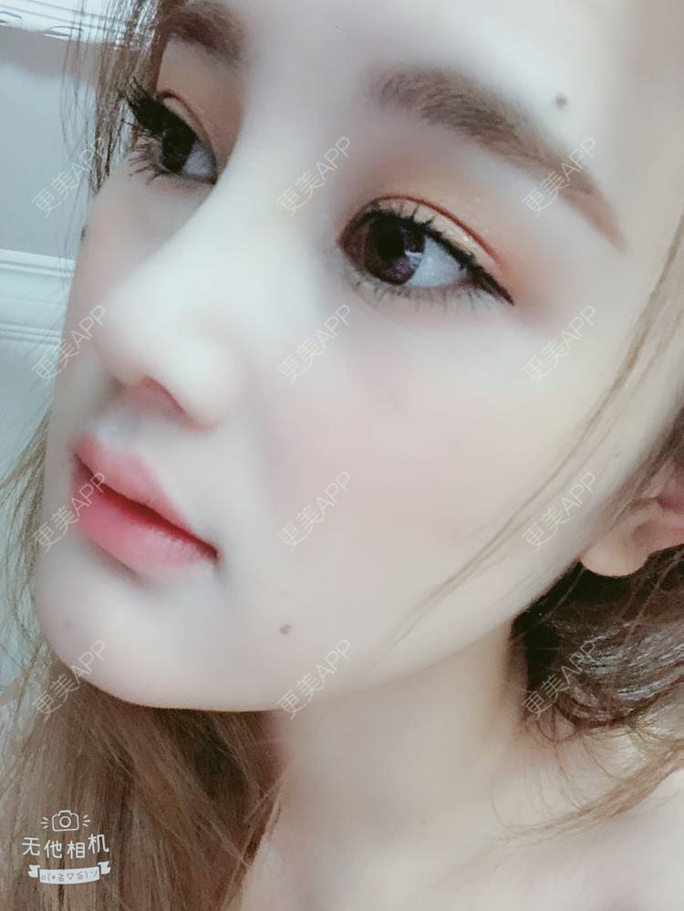 更美 - 爱人不过是碍人的自体软骨垫鼻尖经验 | 自体软骨垫鼻尖 | 膨体隆鼻 | 肋软骨隆鼻 | 鼻中隔软骨隆鼻 | 耳软骨隆鼻 | 上海