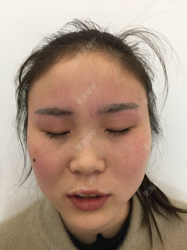 更美 - 更美用户or7ofNg77b的激光洗眉经验 | 激光洗眉 | 郑州