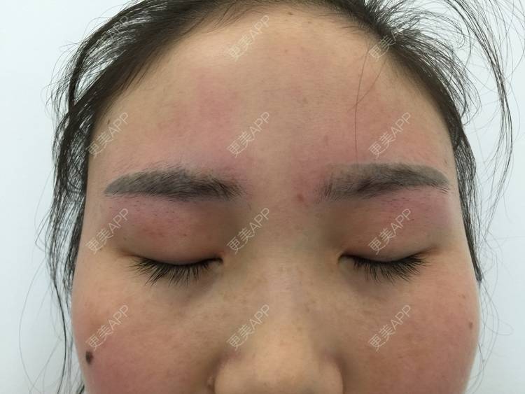 更美 - 更美用户or7ofNg77b的激光洗眉经验 | 激光洗眉 | 郑州
