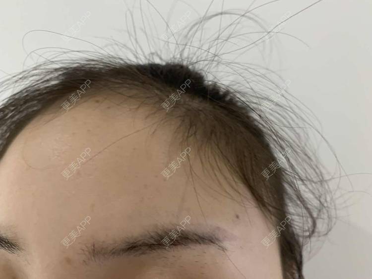 更美 - 更美用户or7ofNg77b的激光洗眉经验 | 激光洗眉 | 郑州