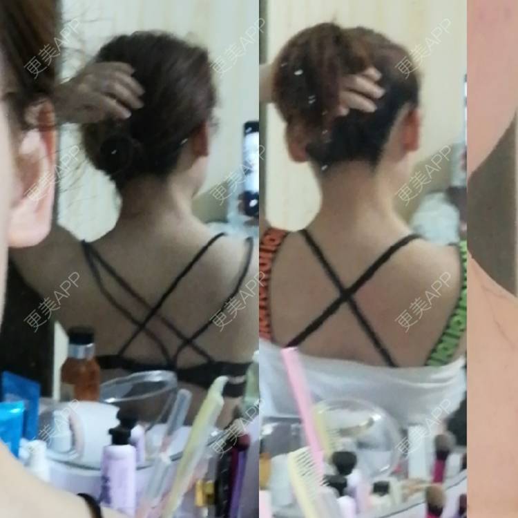 更美 - 王子涵涵的杯状耳矫正经验 | 杯状耳矫正