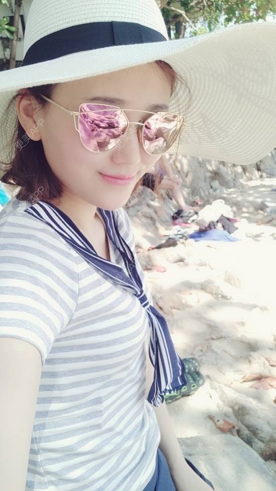更美 - 顽固不化的假体垫苹果肌经验 | 北京 | 假体垫苹果肌