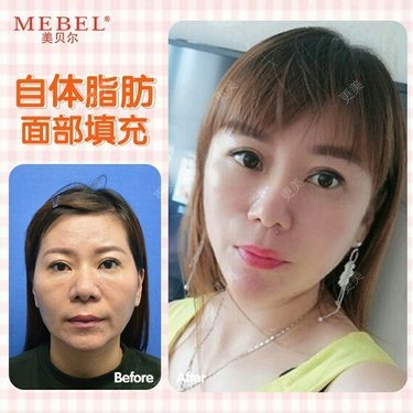 自体脂肪面部填充