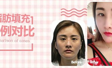 自体脂肪面部填充