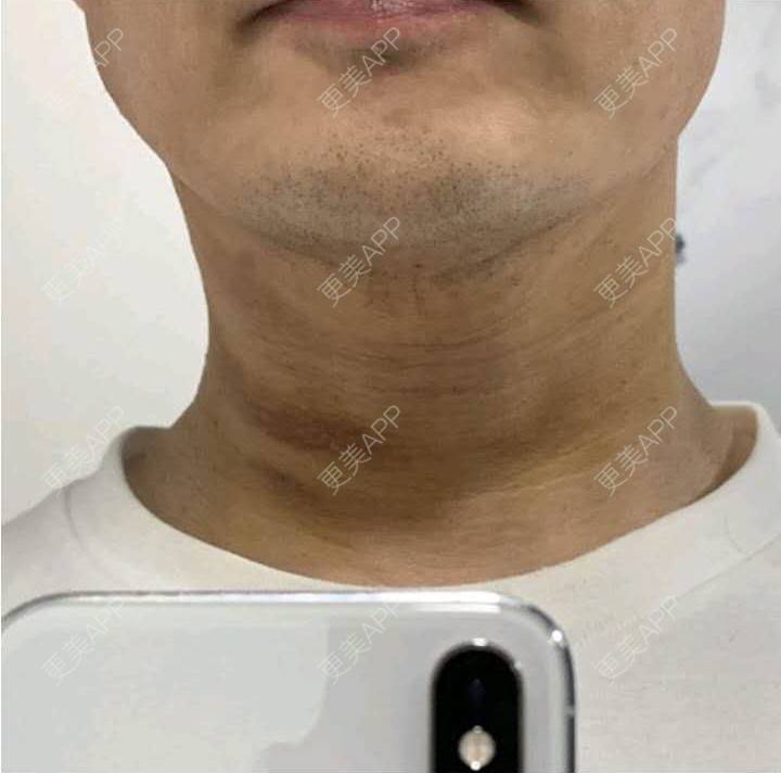 更美 - 中考先森i的双下巴吸脂经验 | 双下巴吸脂