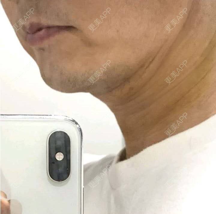 更美 - 中考先森i的双下巴吸脂经验 | 双下巴吸脂