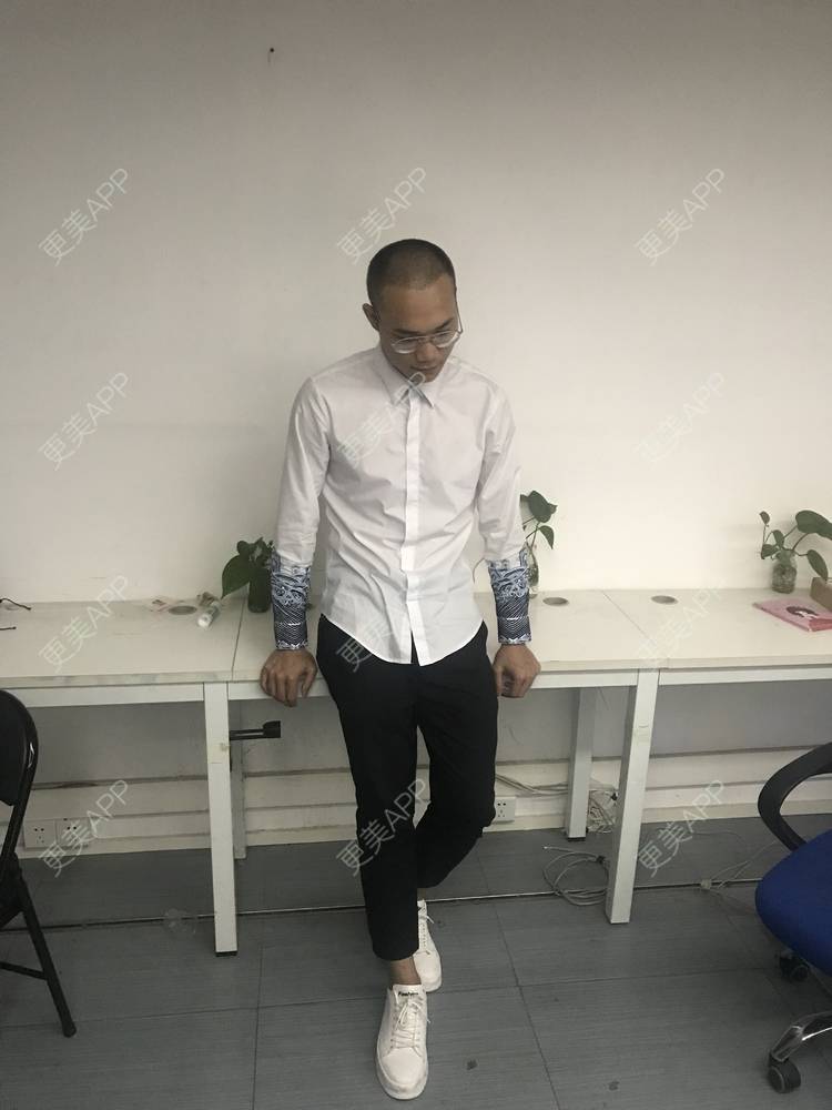 更美 - 更美用户y5O1wsEQkc的鬓角植发经验 | 视频日记 | 鬓角植发 | 广州