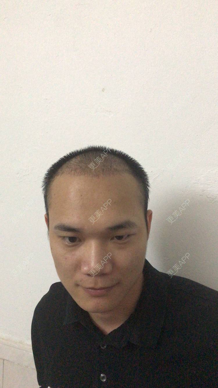 更美 - 更美用户y5O1wsEQkc的鬓角植发经验 | 广州 | 视频日记 | 鬓角植发