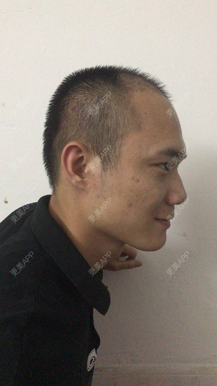 更美 - 更美用户y5O1wsEQkc的鬓角植发经验 | 广州 | 视频日记 | 鬓角植发