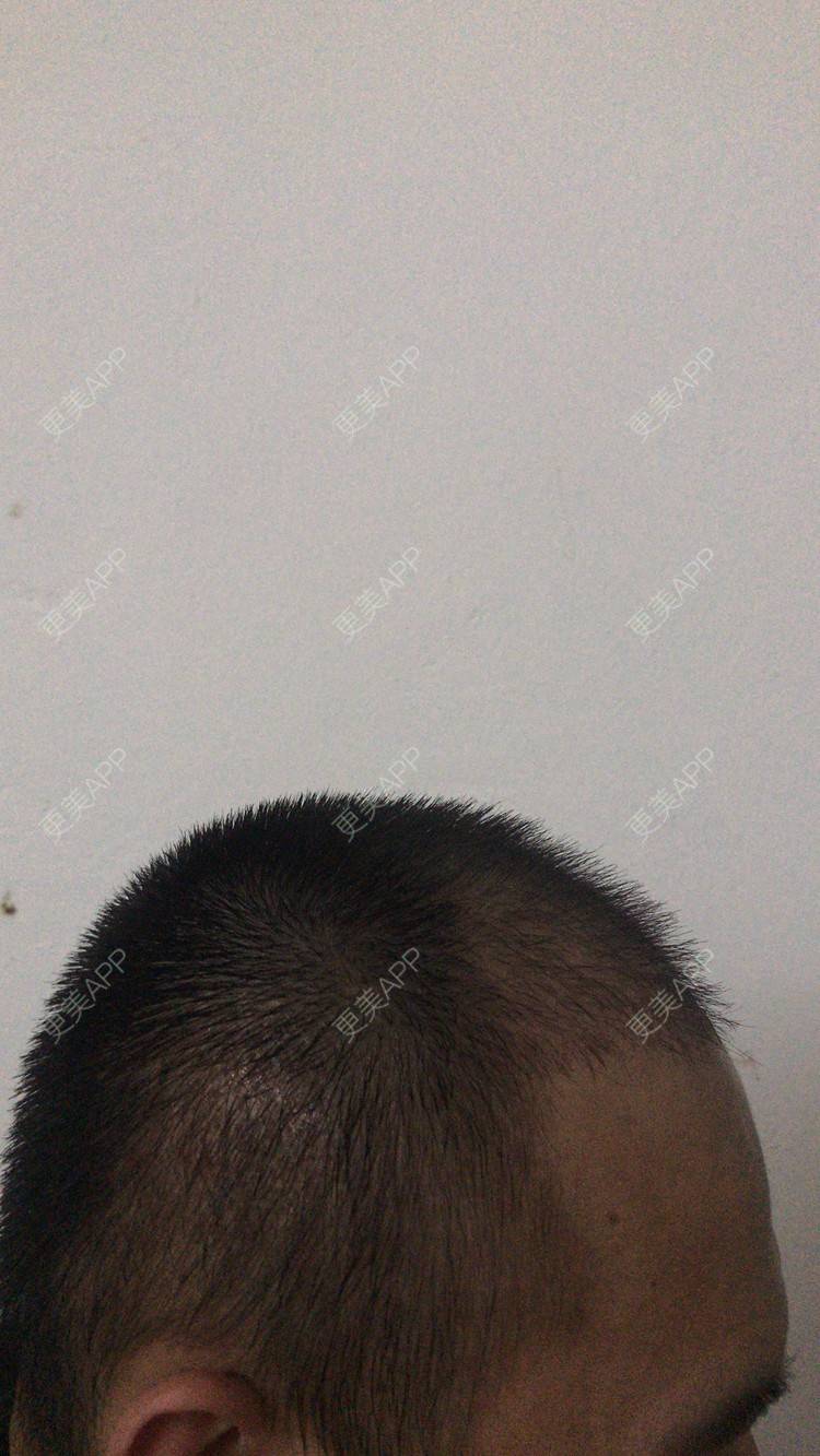 更美 - 更美用户y5O1wsEQkc的鬓角植发经验 | 广州 | 视频日记 | 鬓角植发