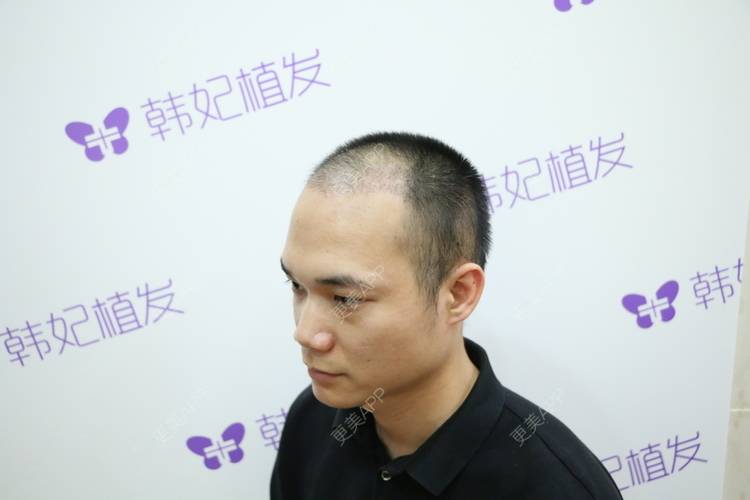 更美 - 更美用户y5O1wsEQkc的鬓角植发经验 | 视频日记 | 鬓角植发 | 广州
