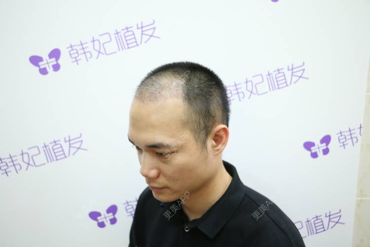 更美 - 更美用户y5O1wsEQkc的鬓角植发经验 | 视频日记 | 鬓角植发 | 广州
